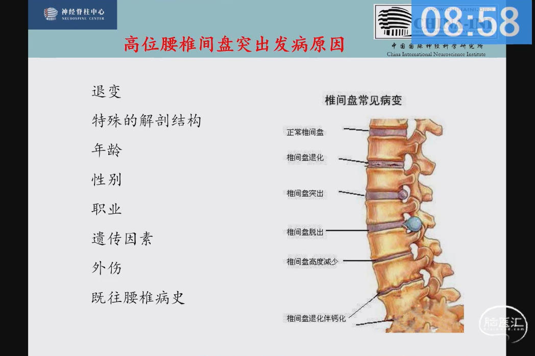王作伟教授：脊柱内镜治疗高位腰椎间盘突出症