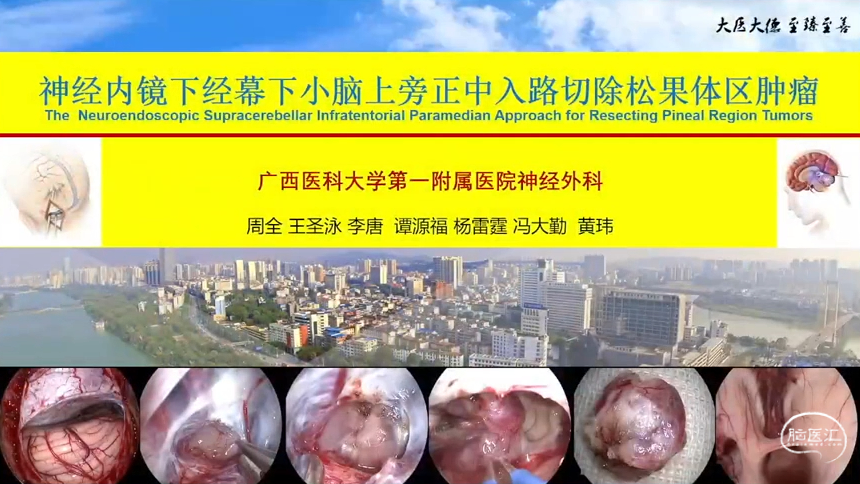 脑医汇_首都医科大学宣武医院神经肿瘤国际会议暨中国解剖学会神经外科分会第二次学术会议、欧美同学会颅底外科分会第四届学术会议 - 神经内镜下脑室病变手术入路选择 - 脑医汇 - 神外资讯 - 神介资讯_1705561550357.png