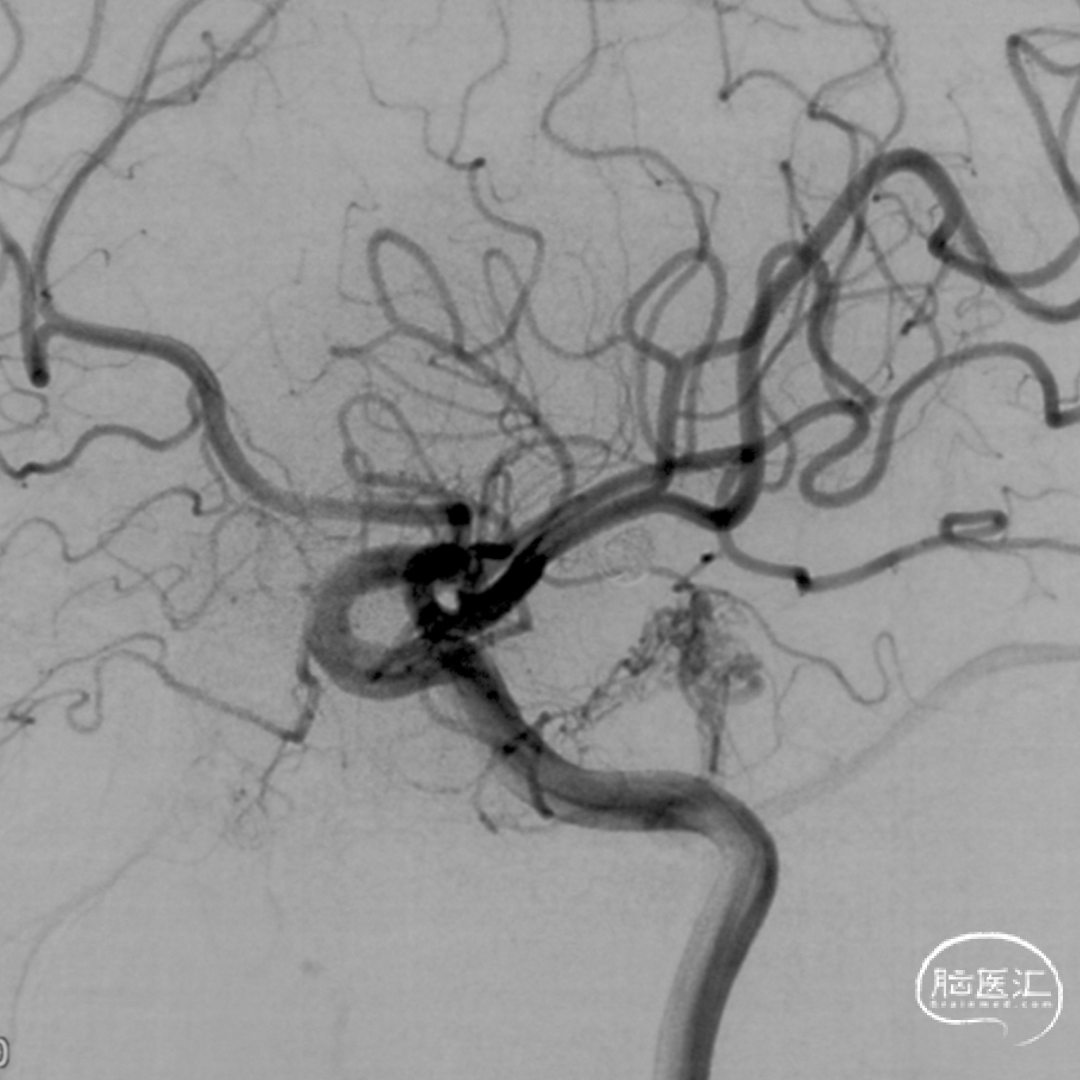 【OCIN CASES】教学病例-43:经颈静脉穿刺联合入路栓塞颞叶动静脉畸形 - 脑医汇