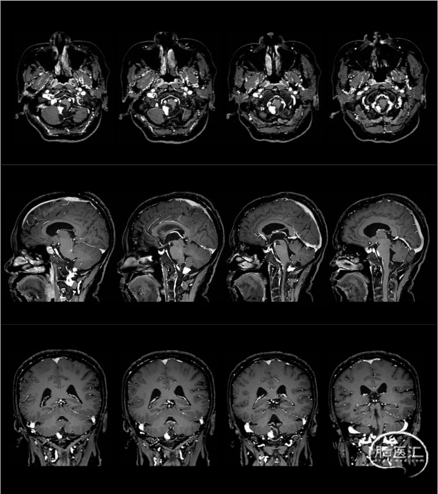 MRI C+.png