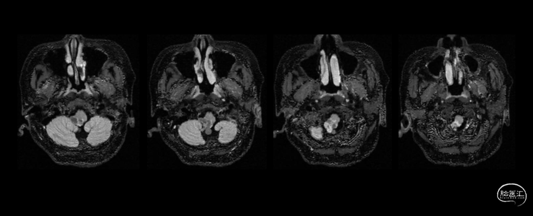 MRI T2flair.png