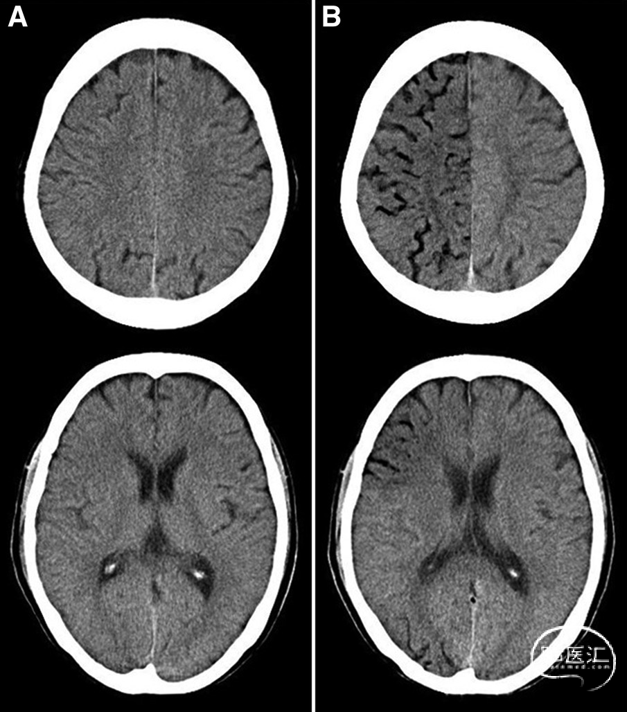 Stroke:脑空气栓塞,动脉还是静脉栓塞? - 脑医汇
