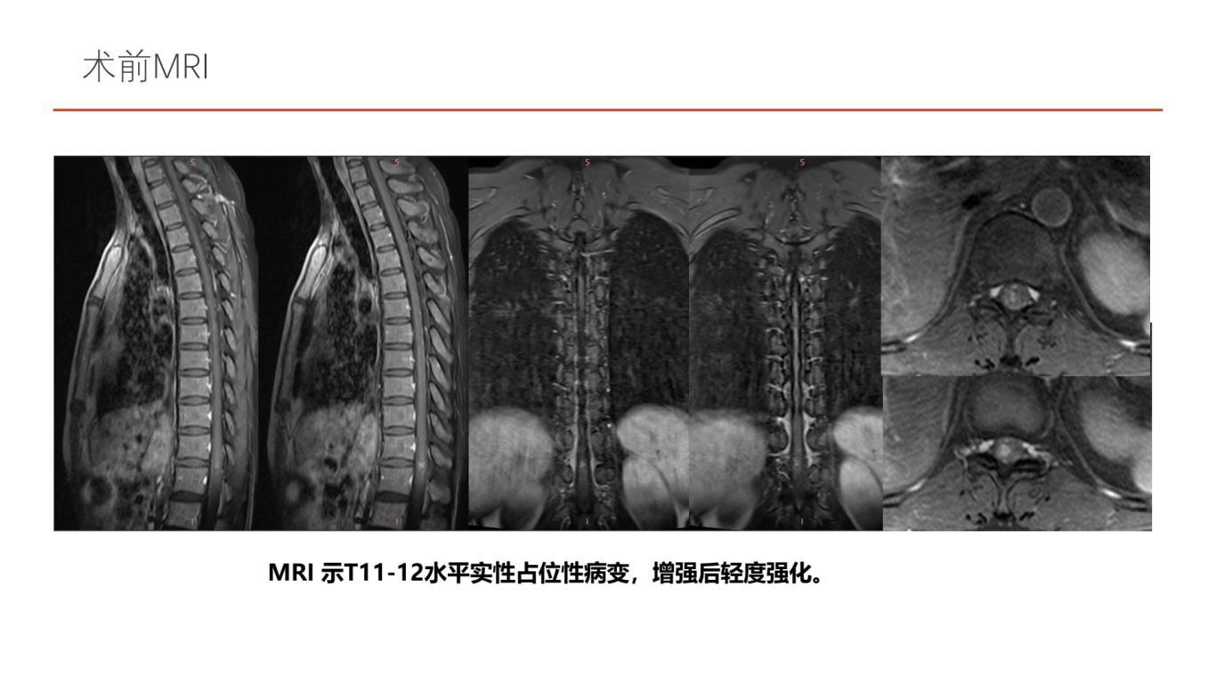 王杰教授团体：一例胸段脊髓海绵状血管瘤伴出血手术切除-逐页转图片-00003.jpg