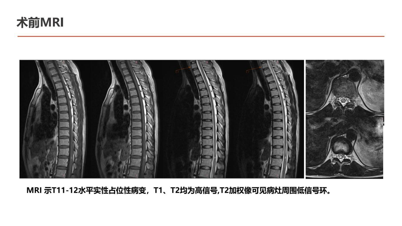 王杰教授团体：一例胸段脊髓海绵状血管瘤伴出血手术切除-逐页转图片-00002.jpg