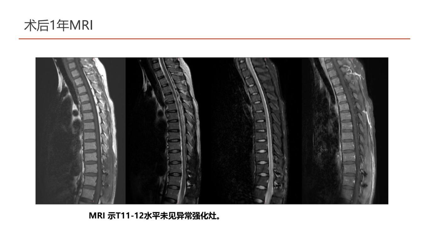 王杰教授团体：一例胸段脊髓海绵状血管瘤伴出血手术切除-逐页转图片-00006.jpg