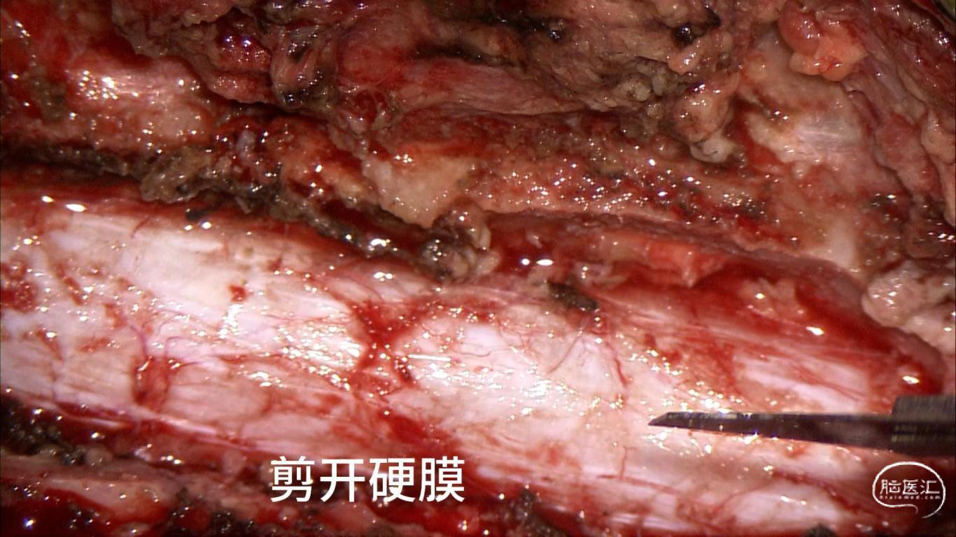 王杰教授团体：一例胸段脊髓海绵状血管瘤伴出血手术切除-逐页转图片-00004.jpg
