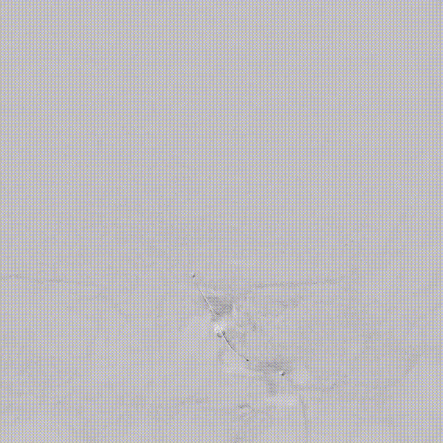 使用0.035 导丝在4F MPA辅助下 00_00_00-00_00_30.gif