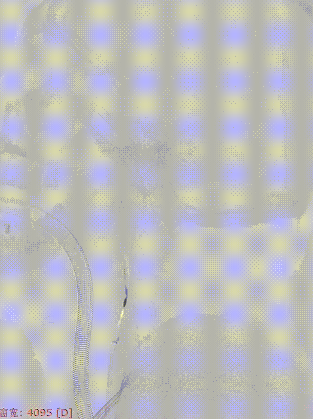 左侧颈内动脉起始部闭塞，颈外动脉-眼动脉 00_00_00-00_00_30.gif