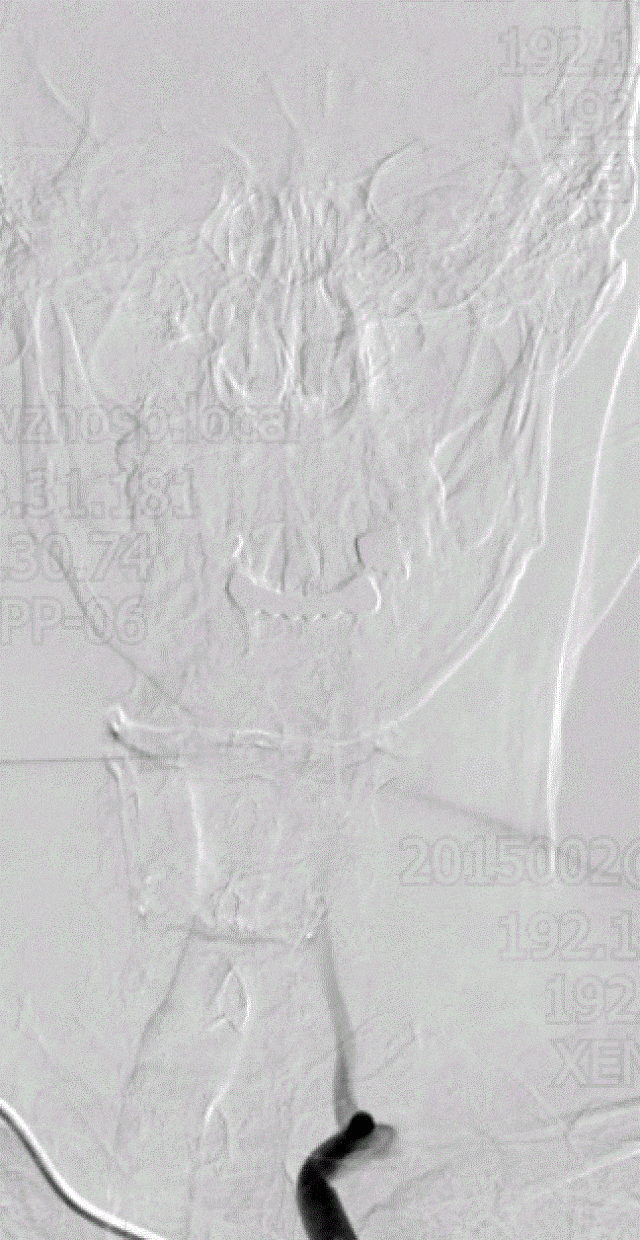 左侧锁骨下动脉正位.gif