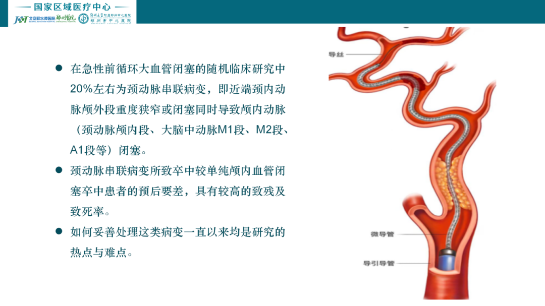 颈内动脉串联病变_03.png