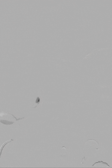 1 术前正侧位造影-正.gif