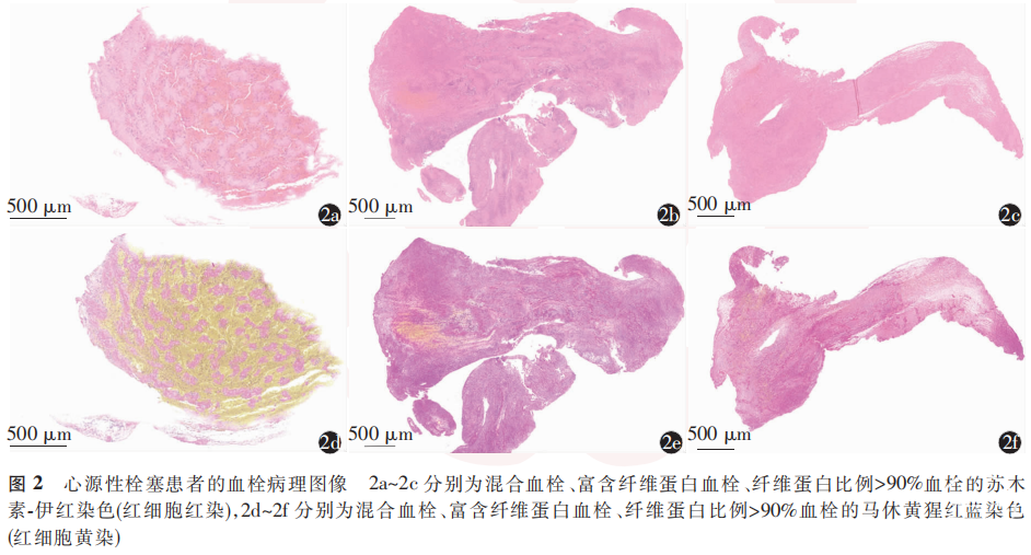 【论著】心脏外科手术围手术期大血管闭塞性急性缺血性卒中患者行血管内治疗的疗效及预后影响因素和血栓病理分析 - 脑医汇