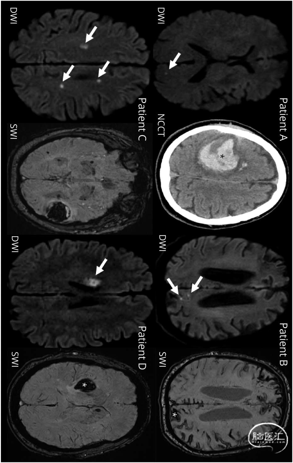 Neurology:脑出血急性期和亚急性期的偶发DWI病灶 - 脑医汇