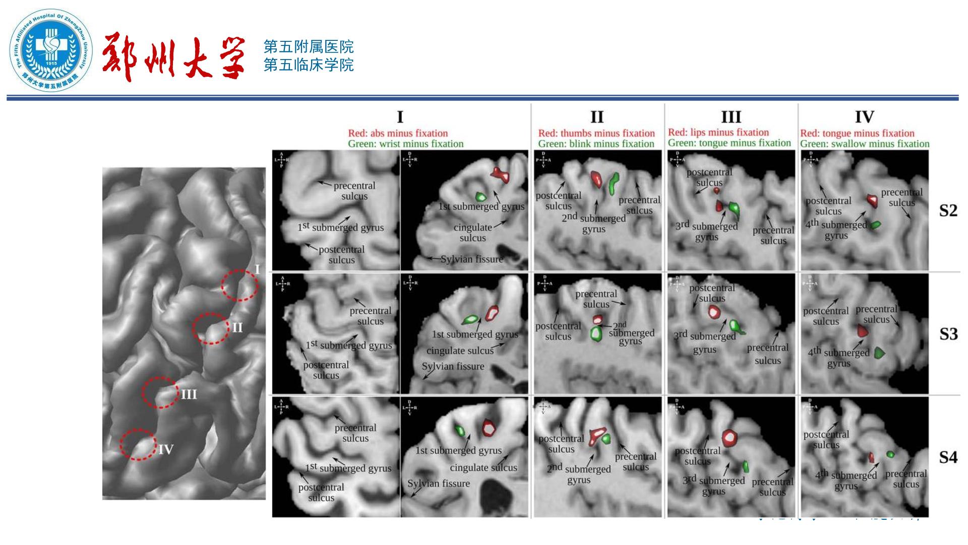 中央沟及毗邻结构的显微解剖 - 脑医汇