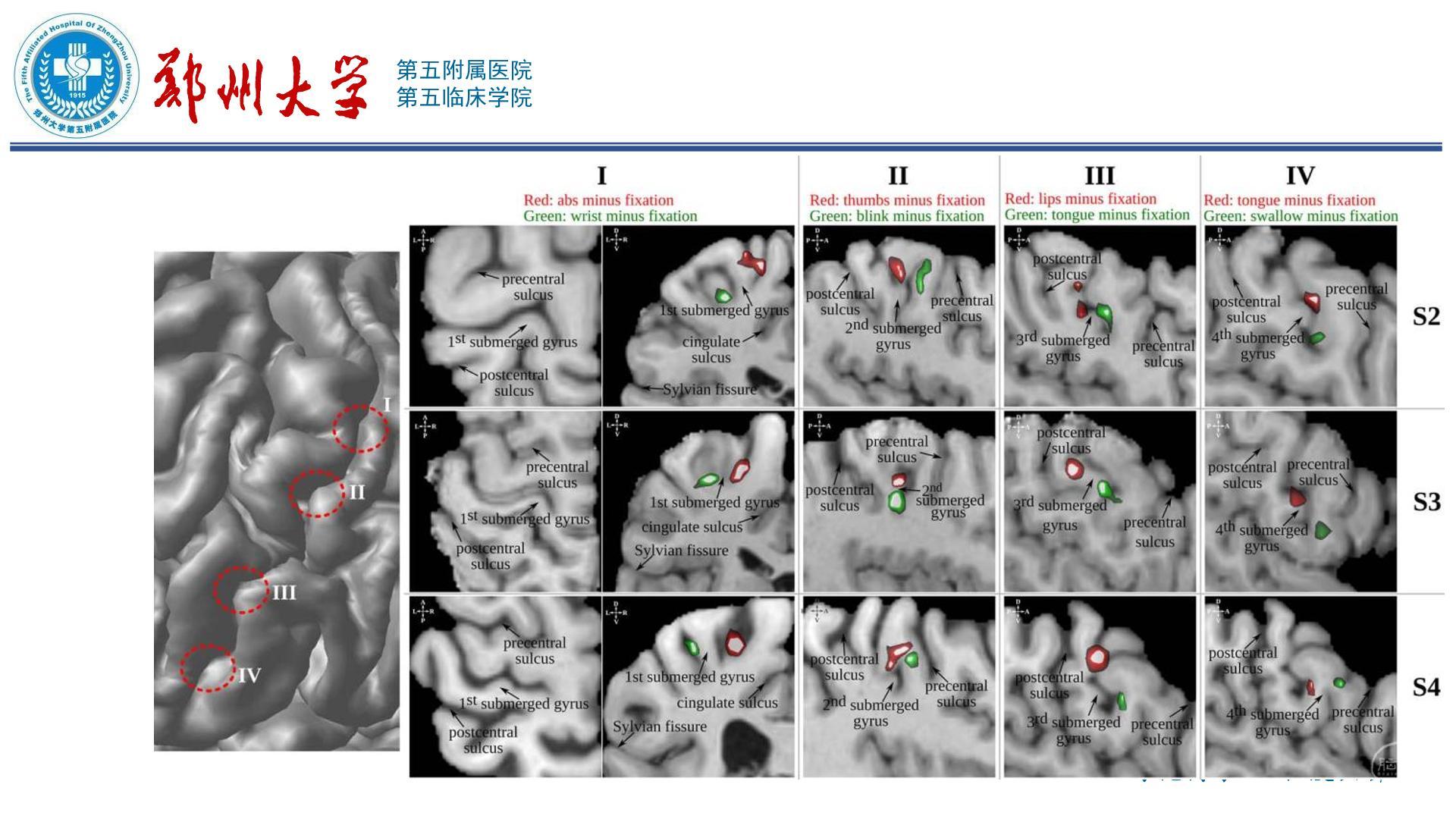 中央沟及毗邻结构的显微解剖 - 脑医汇