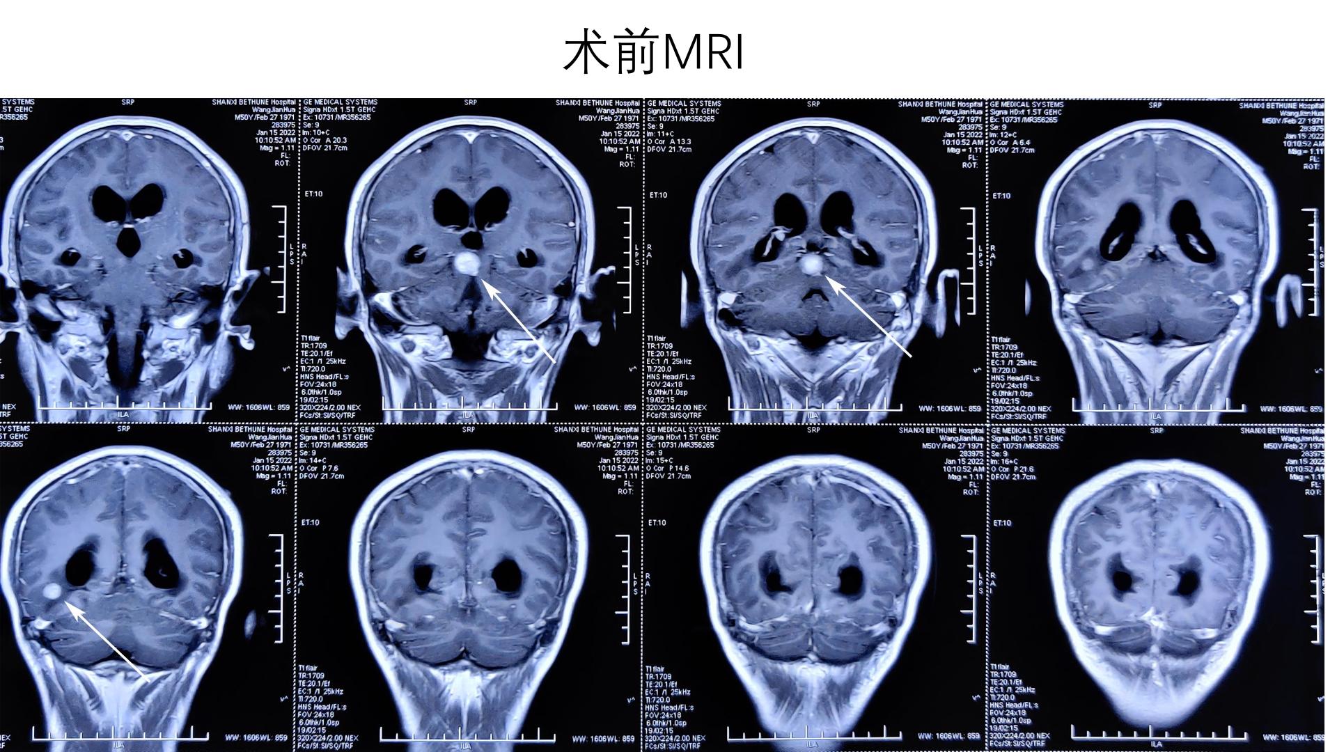 颅内转移瘤:中脑背侧及枕颞占位手术操作 - 脑医汇