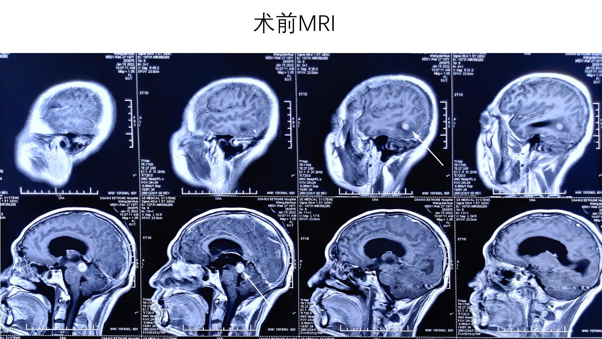 颅内转移瘤:中脑背侧及枕颞占位手术操作 - 脑医汇