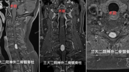 【病例分享】罕见的髓内神经鞘瘤