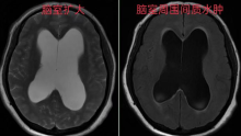 脑积水手术再上新台阶——脑室镜下室间孔成形术、三脑室底造瘘术、透明隔造瘘、脑室内脉络丛电灼术同步实施