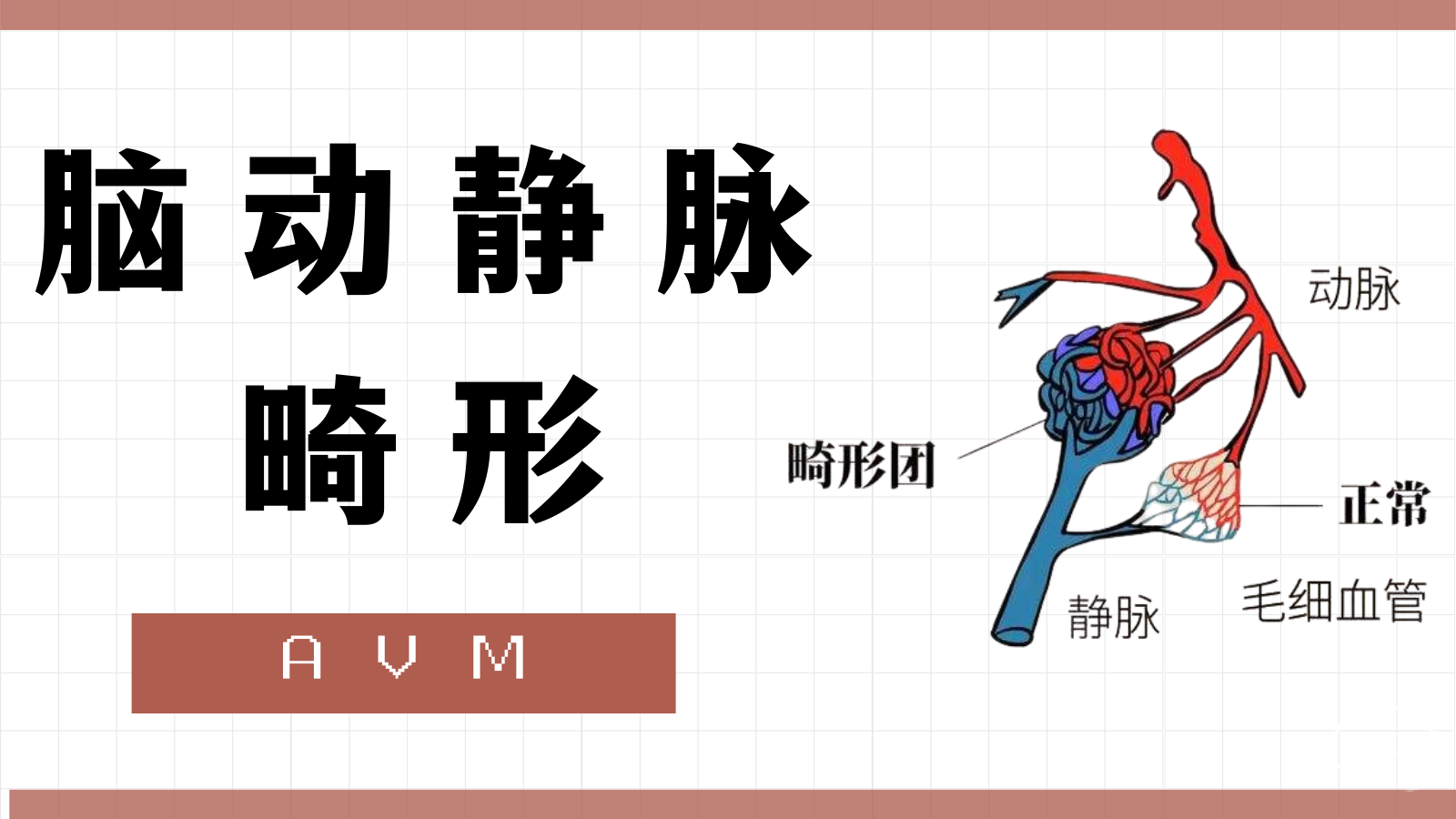 脑动静脉畸形3.png
