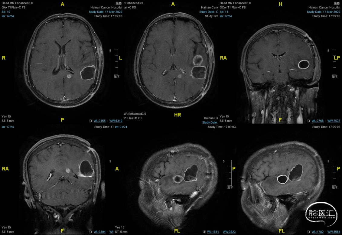 图5-1-47 大脑半球的连合纤维(示胼胝体)-新编人体解剖学-医学