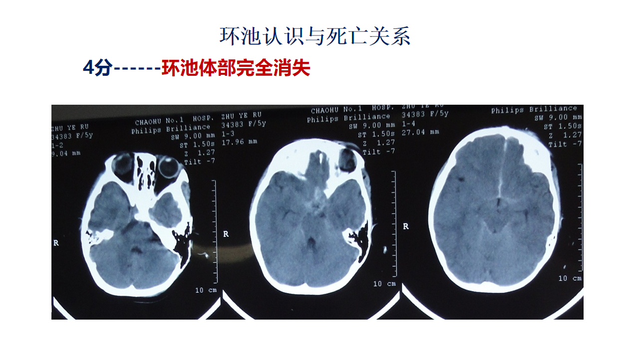脑出血微创锥颅引流技术(2).png