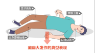 癫痫大发作和小发作你分清楚了吗？出现这些异常要警惕！