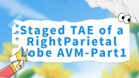 Staged TAE of a Right Parietal Lobe AVM-Part1