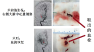 【病例分享】脑血管病介入手术典型病例1