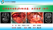 颅底手术丨 蛛网膜外切除CPA脑膜瘤：血管分离与保护（手术录像）