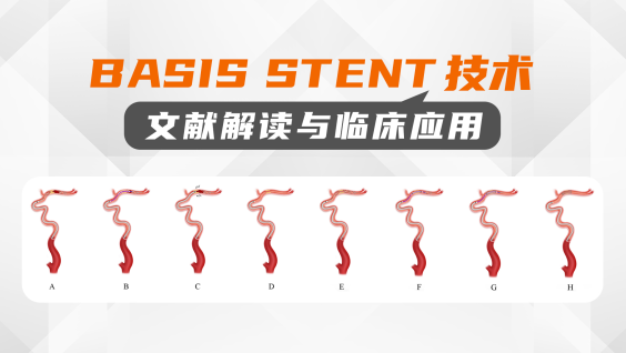 嘉视小讲堂｜易婷玉教授：BASIS STENT技术文献解读与临床应用