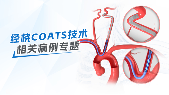 沈建教授｜运用经桡COATS技术建立通路治疗颅内动脉瘤病例专题分享