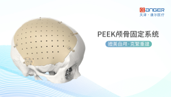 PEEK颅骨固定系统