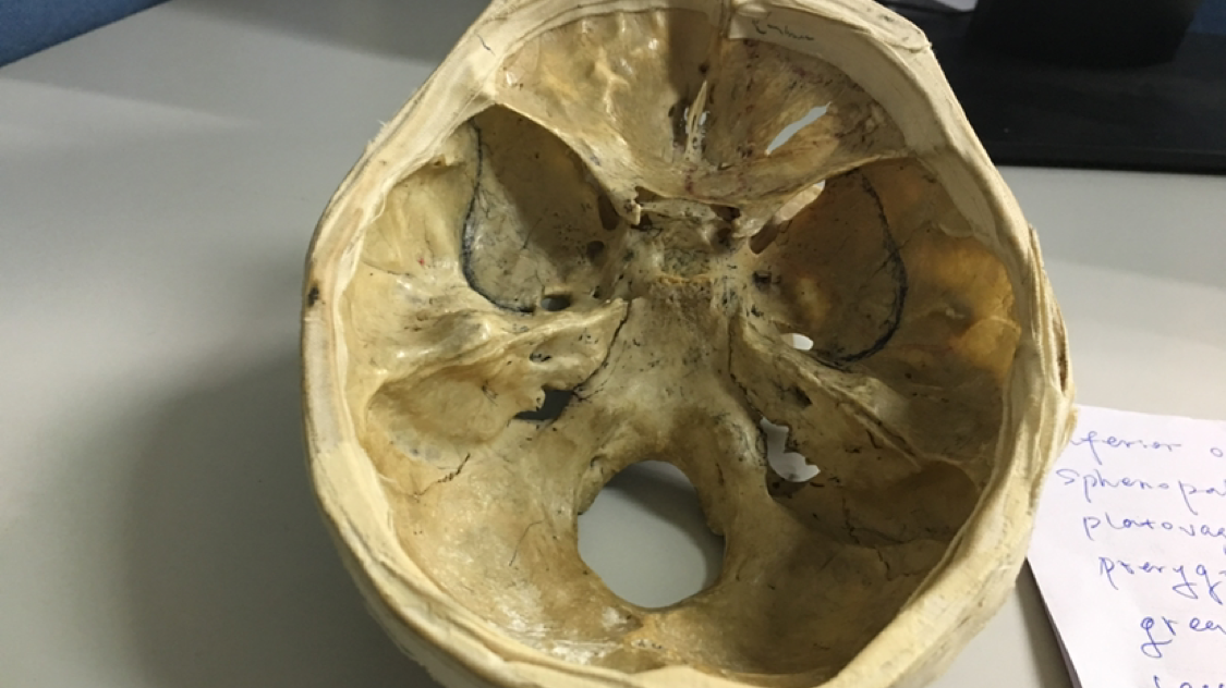 枕骨大孔区解剖和crouzonsyndrom